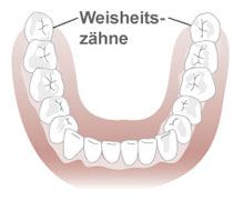 Zahn-/Weisheitszahnentfernung